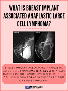 breast implant cancer